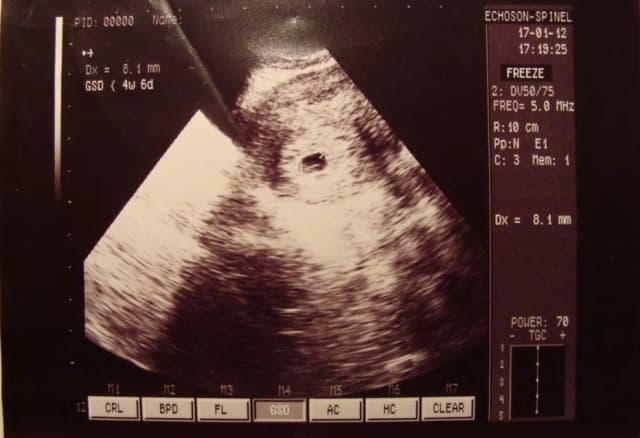 Jak wygląda dziecko w 5 tyg ciąży? Zaskakujący rozwój zarodka