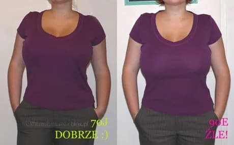 Refundacja zmniejszenia biustu: warunki i zasady NFZ