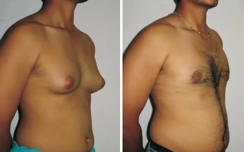 Hormony, które drastycznie zmniejszają piersi. Poznaj prawdziwe powody